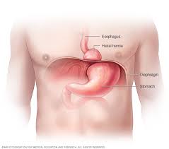 Hiatal Hernia Symptoms And Causes Mayo Clinic