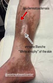Image result for Lipodermatosclerosis