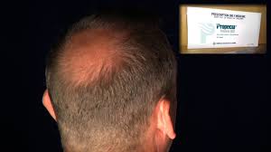 In december 22, 1997 the fda approved propecia as a hair loss pill. Sexual Problems Sometimes Irreversible Side Effect Of Hair Loss Drug Propecia Youtube