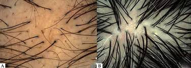 By y on january 8, 2008. Scielo Brasil Female Pattern Hair Loss A Clinical And Pathophysiological Review Female Pattern Hair Loss A Clinical And Pathophysiological Review