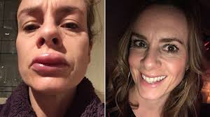 Mom says reaction to cheap teeth-whitening kit left her with swollen,  blistered lips