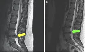Tulang belakang menjadi kurang stabil dan akan mengakibatkan sakit pinggang. Slipped Disc Punca Simptom Dan Cara Rawatan The Diagnosa