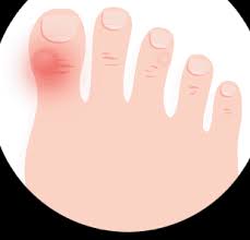 Moreover, the resulting heat and pain can be localized in the soles of feet but can also spread to the tops of the feet, the ankles, and even the lower legs. Identifying Your Foot Pain 2021 Treadmillreviews Net
