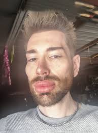 A Man's Drastic Cat-Eye Surgery and Filler Removal Transformation Shocks  Viewers