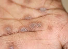 We did not find results for: Syfilis Soa Aids Nederland