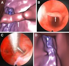 Virtual Ultrasonographic Hysteroscopy Followed By Conventional Operative Hysteroscopy Enabling Pregnancy American Journal Of Obstetrics Gynecology