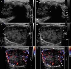 Image result for Multinodular Goiter