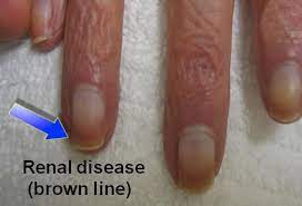 Improving global outcomes (kdigo) acute kidney injury work group. Brown Line Distal To Half Nails Usu Suggests Renal Disease Nursing Tips Nurse Dialysis Nurse