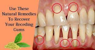 Pin By Rafika Van Loon On Face Body Gum Recession Treatment Gum Disease Treatment Gum Disease