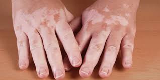 Alles zu ursachen und behandlung der vitiligo lesen sie hier! Vitiligo