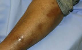 Image result for erythema nodosum