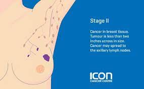 Get information on breast cancer (breast carcinoma) awareness, signs, symptoms, stages, types, treatment, and survival rates. Breast Cancer Types Stages Icon Cancer Centre Singapore