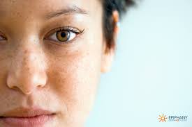 Image result for Freckled skin