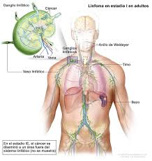 El linfoma no hodgkin (también conocido como lnh o simplemente como linfoma) es un cáncer que comienza en las células llamadas linfocitos, el cual es parte del sistema inmunológico del cuerpo. Linfoma En Estadio I En Adultos Lymphoma Adult Stage I Image Details Nci Visuals Online