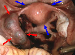 Check spelling or type a new query. Ectopic Pregnancy Wikipedia