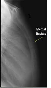 Image result for Sternal Fracture