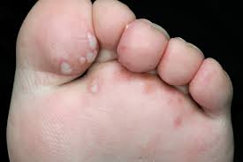 Je vois tout et n'importe quoi sur internet pour les femmes enceintes. Maladie Pieds Mains Bouche Maladies Infectieuses Edition Professionnelle Du Manuel Msd