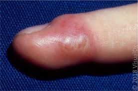 Image result for Hand Infection