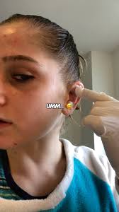 Wow! From Amit Elor… how to avoid Cauliflower Ear.