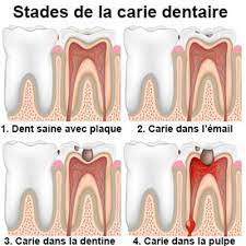 Vous avez une rage de dent ? Que Faire En Cas De Carie Dentaire Docteurclic Com