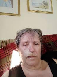 Hertfordshire mum fears she looks like 'Frankenstein's monster' as skin  cancer leaves bald 'craters'