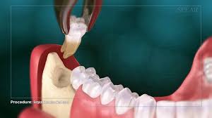In patients with impacted wisdom teeth, the removal procedure can cost from $225 to $600. Wisdom Tooth Removal Pain Advice And Cost Smileworks Liverpool