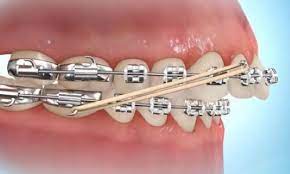 Hopefully they were not downvoted as they were valid. How To Put Rubber Bands On Braces Premier Orthodontics