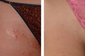 Don't do this), and finally, can i die from an ingrown hair? in short: Ingrown Hair After Epilation 36 Photos How To Get Rid Of Growing Hairs Means For Removing How To Fight In The Bikini Area