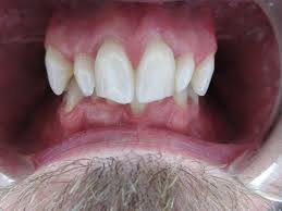 As A 49 Year Old, Will Braces/Invisalign Fix My Canted Smile? Will Braces  Broaden My Smile/Palate? (Photo)
