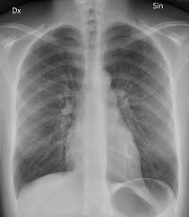 We did not find results for: Chest Radiograph Wikipedia