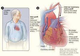 Cardiac Surgery Coronary Artery Bypass Grafting Cabg