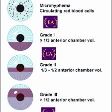 Image result for Hyphema