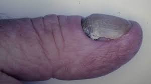 Image result for Yellow nail syndrome feet