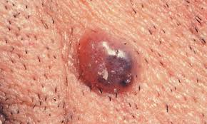 Skin cancer is the most common type of cancer in the united states by a pretty large margin, and it does not discriminate. What Does Skin Cancer Look Like A Visual Guide To Warning Signs Allure