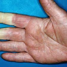 Werden Ihre Finger Bei Kalte Plotzlich Blass Und Taub Dahinter Konnte Eine Krankheit Stecken The Weather Channel Artikel Von The Weather Channel Weather Com