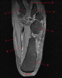 Upper and lower lines mark. Mri Of The Ankle Detailed Anatomy W Radiology