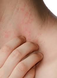 Headaches Hives And Heartburn Could Histamine Be The Cause
