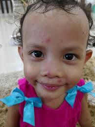Andaikan bayi sudah diberikan susu formula, atau makanan pendamping asi, jangan lupa untuk menyertakan air putih. Chicken Pox Campak Sekam Tips Penjagaan Cara Hilangkan Parut Cepat