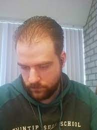 Does this mean my hair is thinning or not? Who Else Has Thinning Hair Neogaf