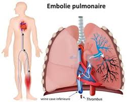 Le point avec le dr stéphane boulé, cardiologue. Embolie Pulmonaire Causes Traitements Quels Signes D Alerte