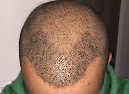 القشور بعد زراعة الشعر طرق العلاج والنصائح الأساسية تركي ويز