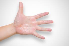 Mechanisms and controllers of eccrine sweating in humans. Clammy Skin Causes Pictures And Treatment