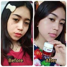 Ada berbagai reaksi yang terjadi dan reaksi tersebut muncul tergantung dari jenis kulit, kondisi kulit. Rk Kosmetik Paket Glow Acne Series With Red Jelly Terbaru Agustus 2021 Harga Murah Kualitas Terjamin Blibli