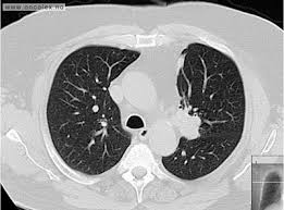 Men i skienskvinnens mage fant legene en stor svulst på 6,2 kilo. Utskriftsvennlig Versjon For Artikkel