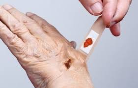 Image result for Skin Tear