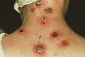 Venereal syphilis is a contagious, systemic disease caused by treponema pallidum. Syphilis Diagnosis And Management Options The Pharmaceutical Journal