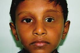 Prosthetic rehabilitation of surgically treated orbital defects ‑  evisceration, enucleation, and exenteration: A case series