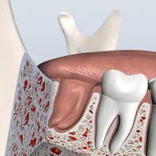 What To Expect When Having A Tooth Extracted