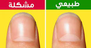 13 مشكلة صحية قد تكشفها هليلات أظافرك