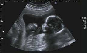 Image result for First Trimester Ultrasound